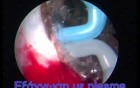 TURis Plasma Vaporization