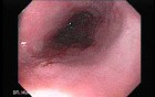 Endoscopic view of Barrett Esophagus residual island of Barrett's tongues (9 of 9)