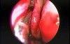 Intranasal Maxillary Sinus Antrostomy - Endoscopy