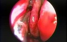 Intranasal Maxillary Sinus Antrostomy - Endoscopy