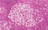 Alcoholic Liver Disease