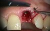 Immediate Implant, Provisional, Papilla And Fenestration Repair