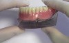 4-Mini Implant Overdenture - Model Demonstration