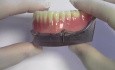 4-Mini Implant Overdenture - Model Demonstration