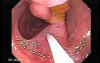 Colonoscopic Polypectomy (5 of 18)