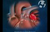 Atrial Fibrillation