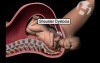 Fundal Pressure