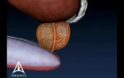 Prostate Biopsy - 3D Medical Animation 