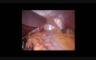 Single-Site Laparoscopic Adjustable Gastric Banding - Initial Experience