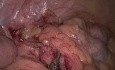 SILS method in appendectomy