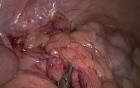 SILS method in appendectomy