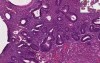 Endometrium - Hyperplasia