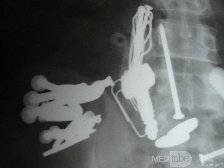 Multiple Foreign bodies in the GI tract (7 of 12)