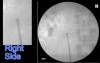 Ureteric Stent Deployment