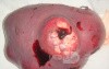 Non-Hodgkin's lymphoma of the spleen