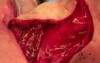 Pharyngoesophageal Reconstruction