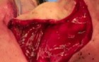 Pharyngoesophageal Reconstruction