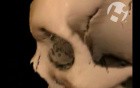 Skull and Facial Fractures