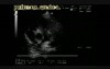 Infective Endocarditis: Vegetation On The Pulmonic Valve