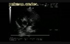 Infective Endocarditis: Vegetation On The Pulmonic Valve