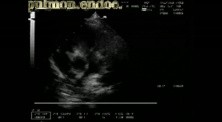 Infective Endocarditis: Vegetation On The Pulmonic Valve