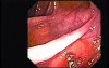 Colonic Lipoma (4 of 4)