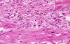 Myocardial Infarction - Recent