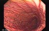High resolution upper GI endoscopy video