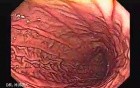 High resolution upper GI endoscopy video