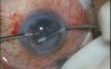 Phacoemulsification - Horizontal Chopping