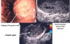 Post-traumatic "cavernoma" of the Pancreas