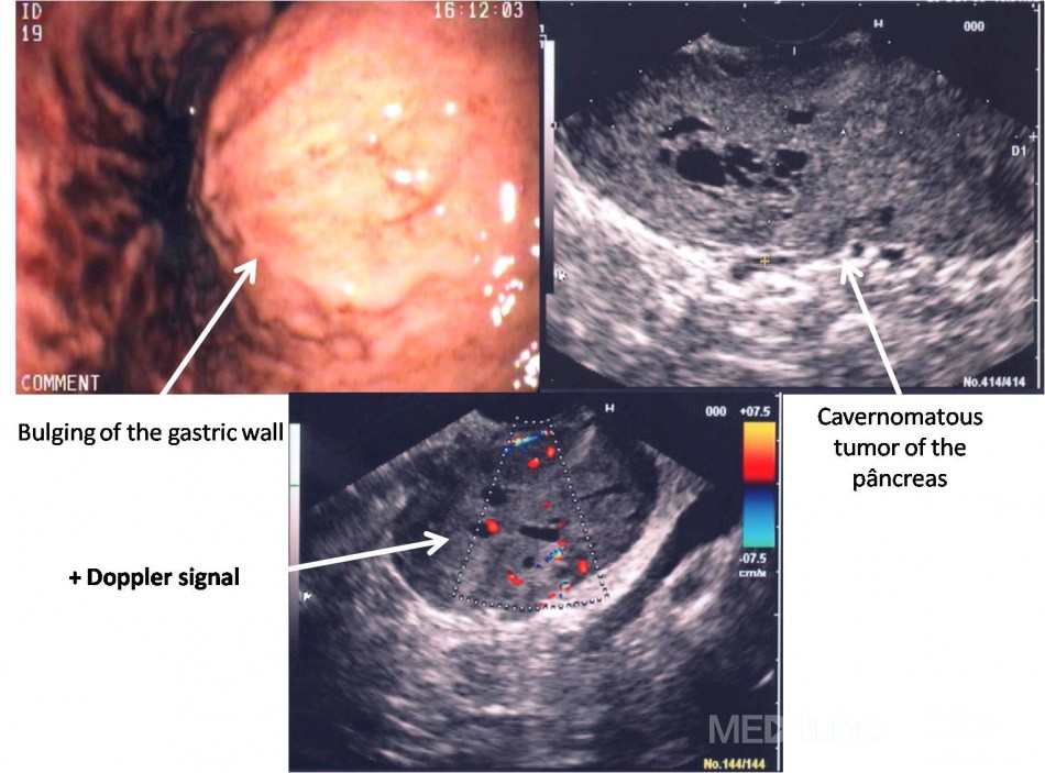 Post-traumatic "cavernoma" of the Pancreas