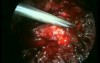 Excision of the Uterus