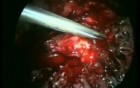 Excision of the Uterus