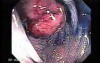 Colonoscopic Polypectomy (6 of 23)