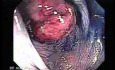 Colonoscopic Polypectomy (6 of 23)