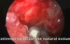 FESS After Caldwell-Luc Procedure