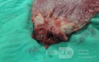 Gastric Ulcerated Adenocarcinoma of the Pre-pyloric Antrum (25 of 28)