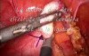Laparoscopic Appendectomy 