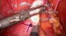 Laparoscopic Appendectomy 