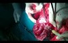 Excision of Leiomyomas - 35 Years Old Virgin