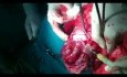 Excision of Leiomyomas - 35 Years Old Virgin