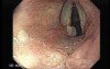 Laryngopharyngeal reflux (LPR)