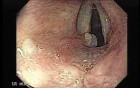Laryngopharyngeal reflux (LPR)