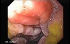 Gastroduodenal MALT lymphoma (5 of 9)