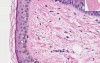 Lentigo - Histopathology of skin