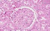 Kidney - Systemic Lupus Erythematosus