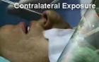 Bloodless Rhinoplasty by Dr Serdev 