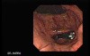 The Upper Gastrointestinal Tract - Video Endoscopic Sequence (5 of 6)