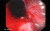 Long Standing Alcohol Abuse - Spurting Esophageal Varix